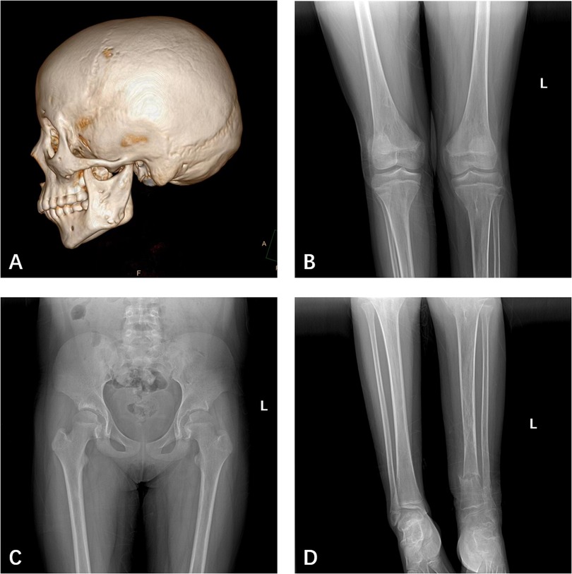 Composite image of medical scans: A) 3D side view of a skull; B) X-ray of knees from the front showing both patellas; C) X-ray of the pelvis and upper legs; D) X-ray of the lower legs and ankles.