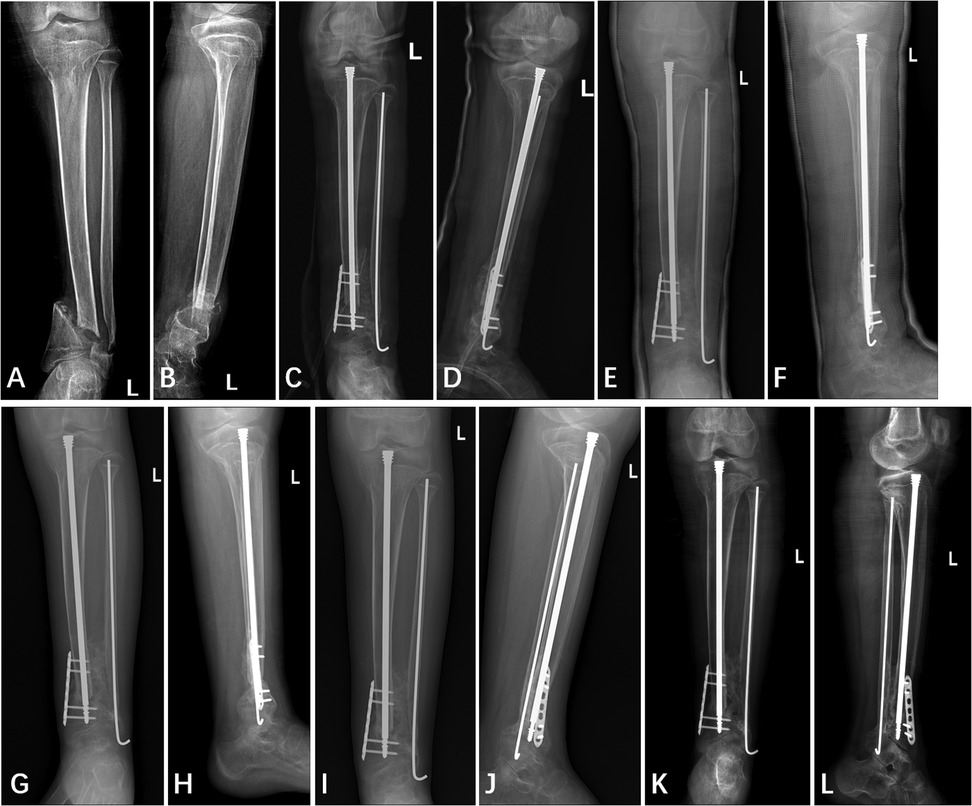 Series of X-ray images showing a tibial fracture treatment with fixation devices. Images A and B display the fracture. Images C to L depict progressive stages of internal fixation using nails and screws, viewed from various angles. Each image is labeled with a letter for reference.