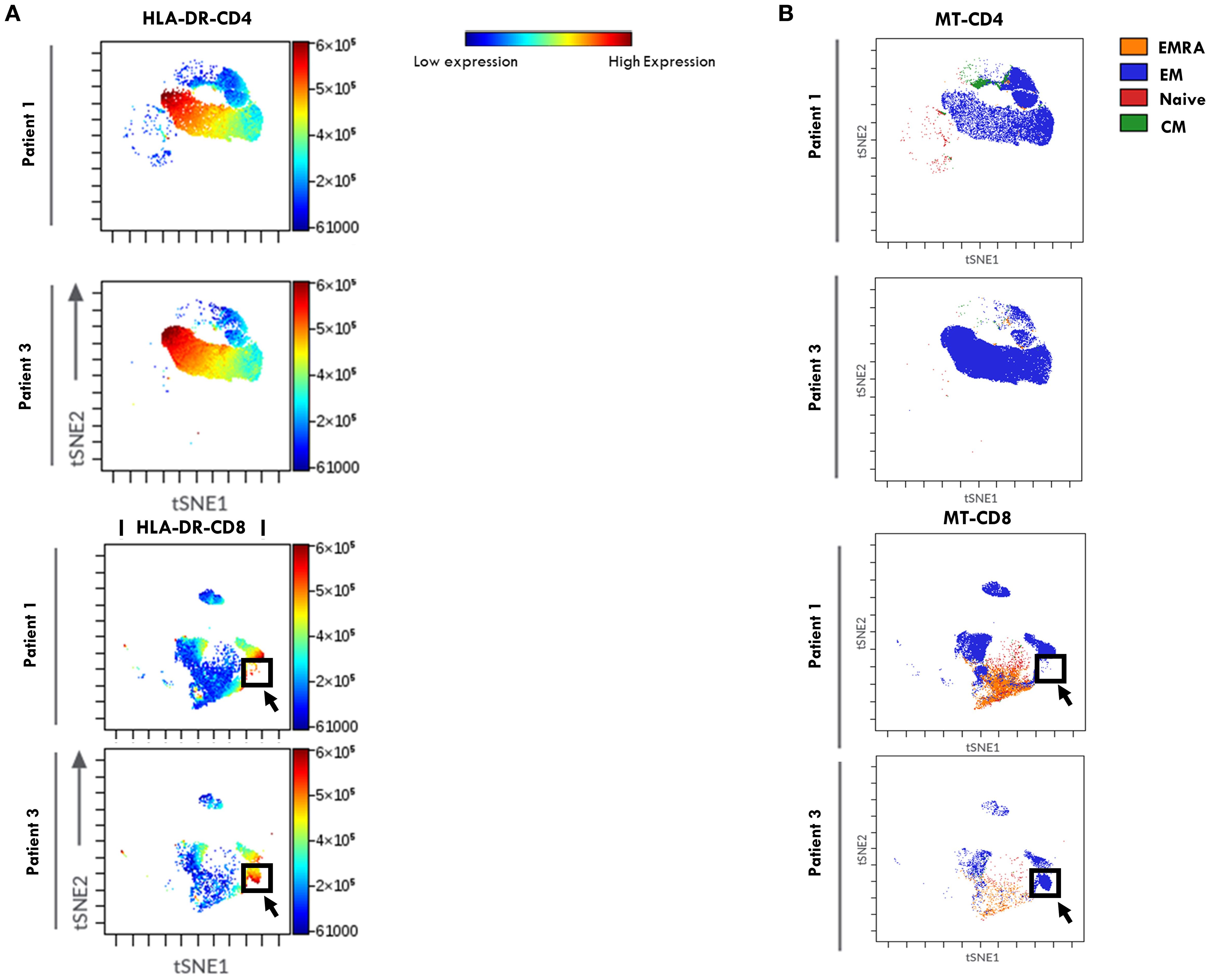 Two panels show viSNE scatter plots of T cell analysis in SF from representative patients 1 and 3. Panel A depicts the expression levels in HLA-DR-CD4 and HLA-DR-CD8 cells, with color ranging from blue (low) to red (high). Panel B indicates different T cell subtypes by FlowSOM clustering using different colors: EMRA (orange), EM (blue), Naive (red), and CM (green). Arrows highlight specific clusters.