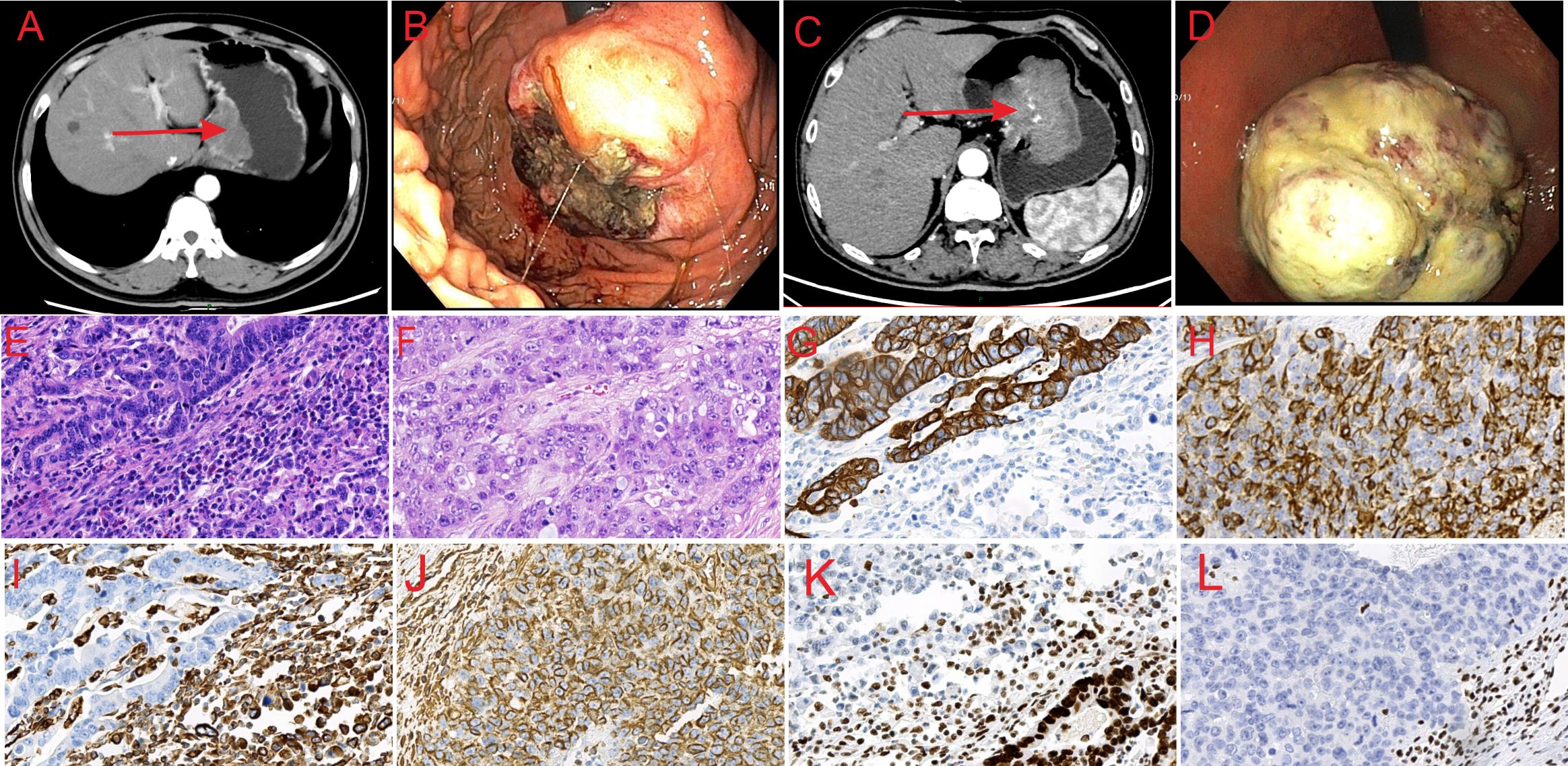 A series of medical images showing scans and microscope slides. Panels A and C display CT scans with arrows pointing to masses. Panels B and D are endoscopic views of similar tissue growths. Panels E and F show histological slides stained to reveal cellular structures. Panels G to L are immunohistochemistry slides, each stained differently to highlight specific proteins or cellular components. Each panel is labeled from A to L for reference.