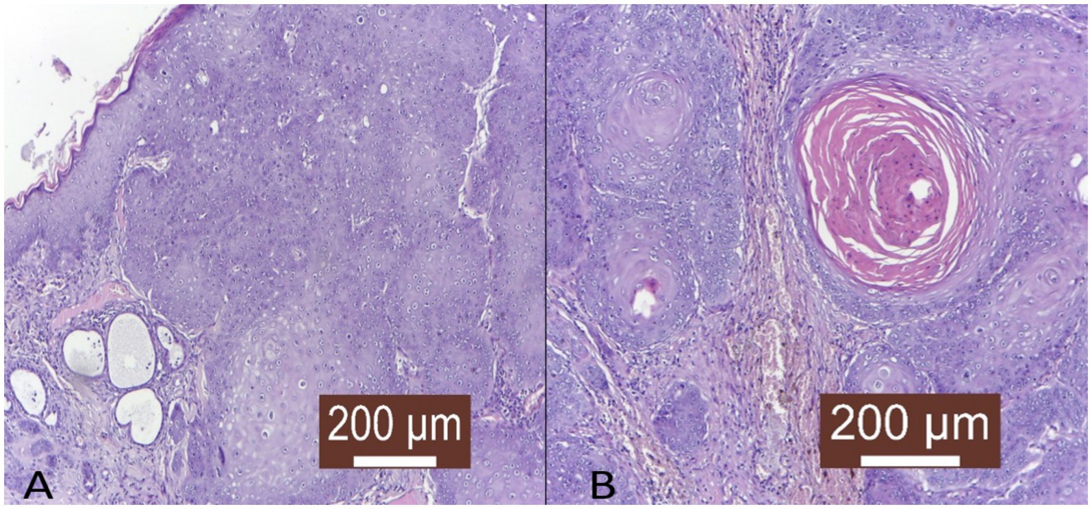 Histopathological representation of feline oral squamous cell carcinoma is shown in two panels labeled A and B. (A) Demonstrates irregular, diffuse, and columnar tumor infiltration extending into the deep layers of the skin, characterized by the formation of keratin-rich tumor islands. (B) Illustrates a tumor islet with a high keratin content located in the profound layer of the skin. Both panels include a scale bar indicating 200 micrometers.