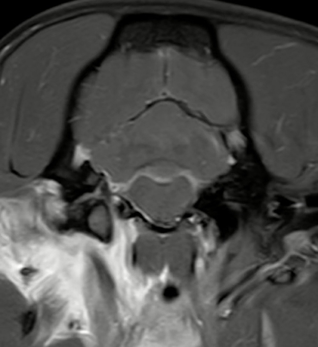 MRI scan of a neck in a transaxial view showing detailed anatomical structures. The image displays variations in tissue density, highlighting muscles, vertebrae, and surrounding areas.