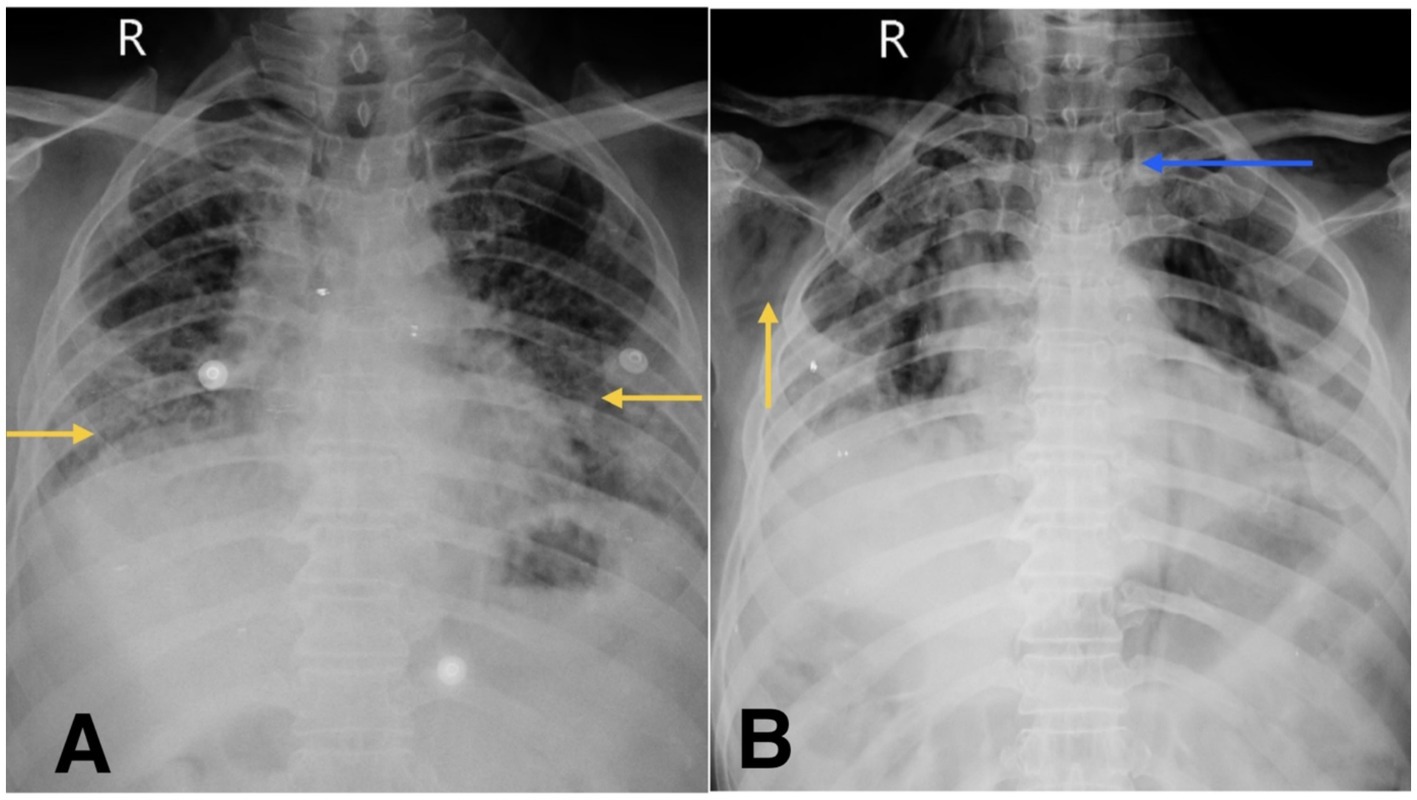 Chest X-ray images labeled A and B. Both show the upper body with an emphasis on the lungs. Image A has two yellow arrows pointing to certain areas, likely indicating abnormalities. Image B has one yellow arrow and one blue arrow, also highlighting specific regions of interest.