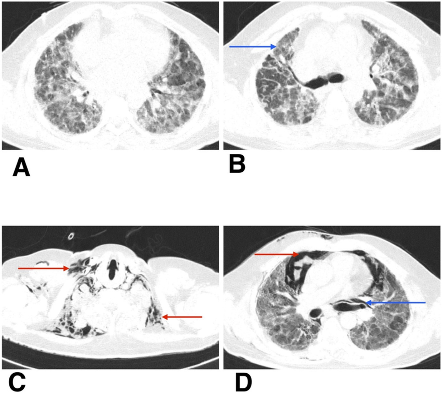 Four-panel CT scan images of the chest. Panel A shows lung opacities bilaterally. Panel B highlights a finding with a blue arrow in the right lung. Panel C displays two red arrows pointing to areas near the lung and chest wall. Panel D has a red arrow indicating a structure near the heart and a blue arrow pointing to the right lung.