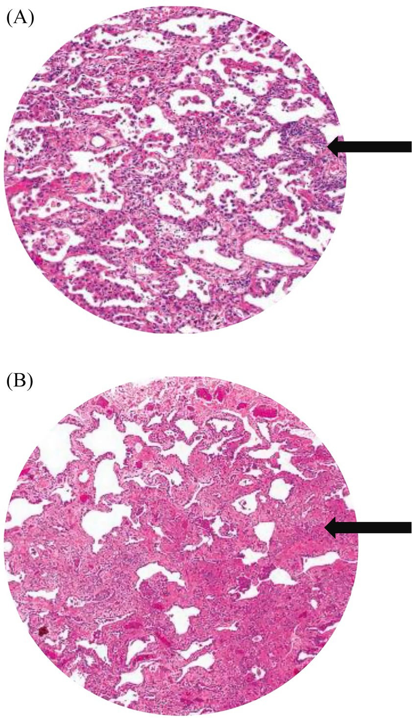 (A) and (B) display two histological images of lung tissue. (A) shows densely packed cellular structures with less white space, while (B) exhibits more open spaces and less cellular density. Both images have arrows pointing towards specific areas of interest.