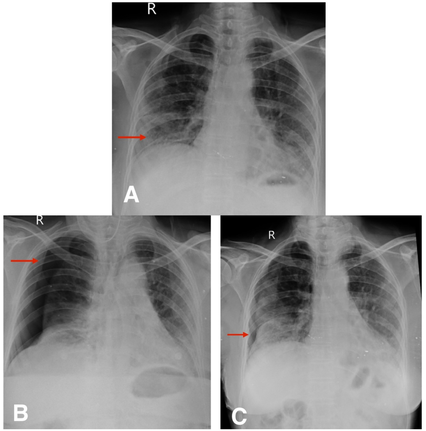 Three X-ray images labeled A, B, and C, each with a red arrow pointing to different areas in the chest. Image A highlights the right lower lung area, image B focuses on the upper right lung, and image C points to the lower right chest near the diaphragm.