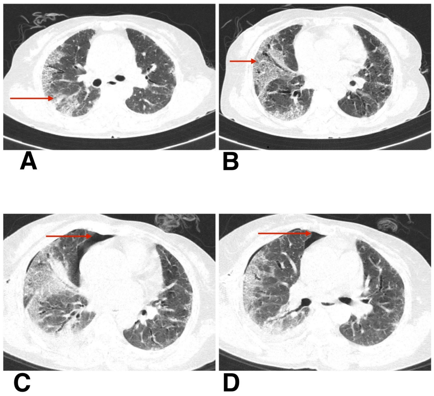 CT scan images labeled A, B, C, and D, each showing transverse sections of lungs. Red arrows point to areas of interest in the lung tissues, indicating potential abnormalities or regions requiring evaluation.