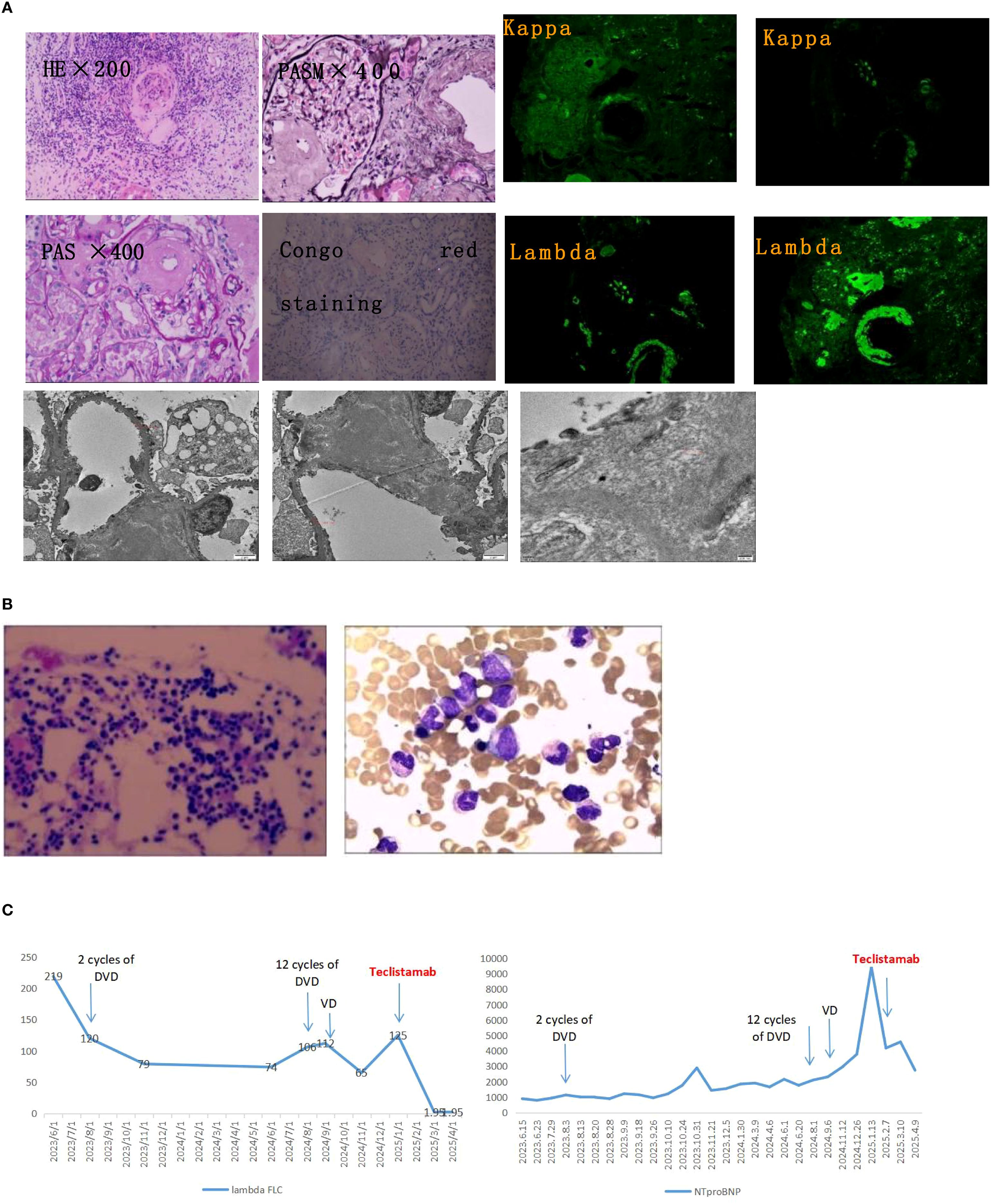 Panel A shows microscopic images including H&E and PASM stained tissue, Congo red staining, and immunofluorescence for kappa and lambda light chains. Panel B displays histological slides with purple-stained cells. Panel C features two line graphs; one shows lambda free light chains over time with annotated treatment milestones, the other illustrates NT-proBNP levels, also annotated with treatment events.