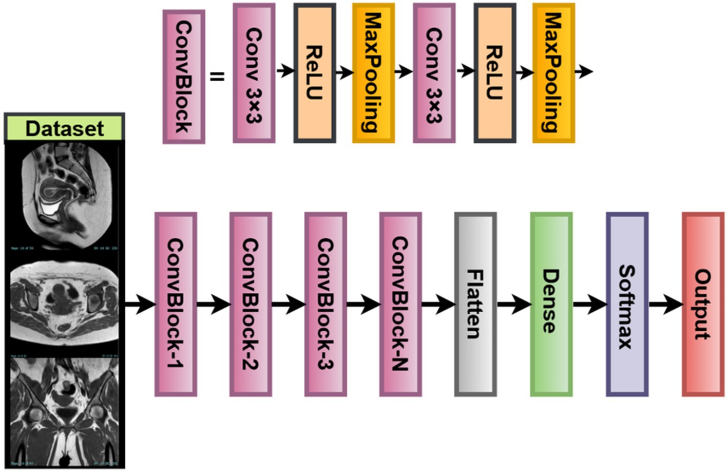 Flowchart illustrating a convolutional neural network (CNN) architecture. Starting with a dataset of medical images, the data passes through multiple ConvBlocks consisting of convolution, ReLU activation, and max pooling. The output is then flattened, followed by a dense layer, softmax activation, and ultimately produces the final output.