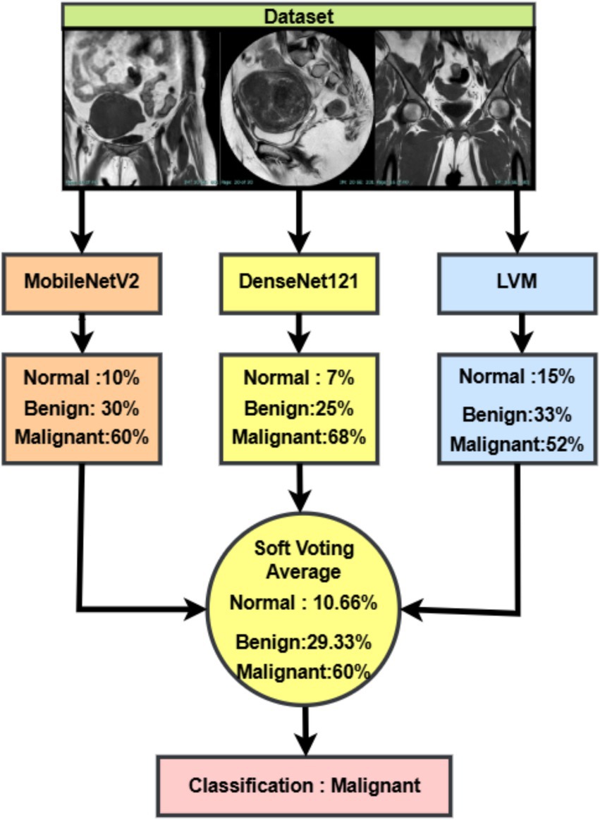 Flowchart depicting a medical image classification process. The dataset is analyzed using three models: MobileNetV2, DenseNet121, and LVM. MobileNetV2 results: 10% Normal, 30% Benign, 60% Malignant. DenseNet121 results: 7% Normal, 25% Benign, 68% Malignant. LVM results: 15% Normal, 33% Benign, 52% Malignant. Soft Voting Average final results: 10.66% Normal, 29.33% Benign, 60% Malignant, leading to a classification of Malignant.