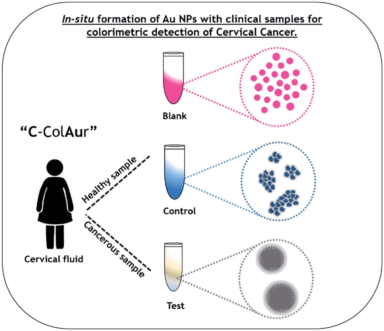 Diagram showing the process of in-situ formation of gold nanoparticles for colorimetric detection of cervical cancer. It compares a blank sample with pink spheres, a control with blue clusters, and a test with gray circles representing cervical fluid. The term “C-CoIAur” is labeled alongside a figure representing a female, indicating the source of the cervical fluid samples used in the test for cancerous versus healthy samples.