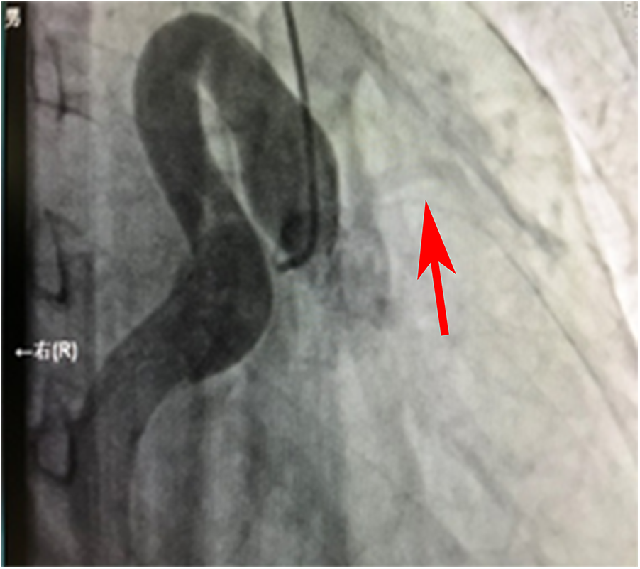 X-ray image showing a catheter inserted into a large, twisted artery. A red arrow indicates an area of interest within the arterial structure.