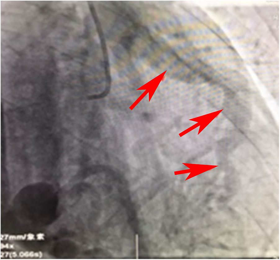 X-ray image shows several red arrows pointing to dark, curved lines, possibly indicating blood vessels or abnormalities. The background is a grayscale anatomical structure.