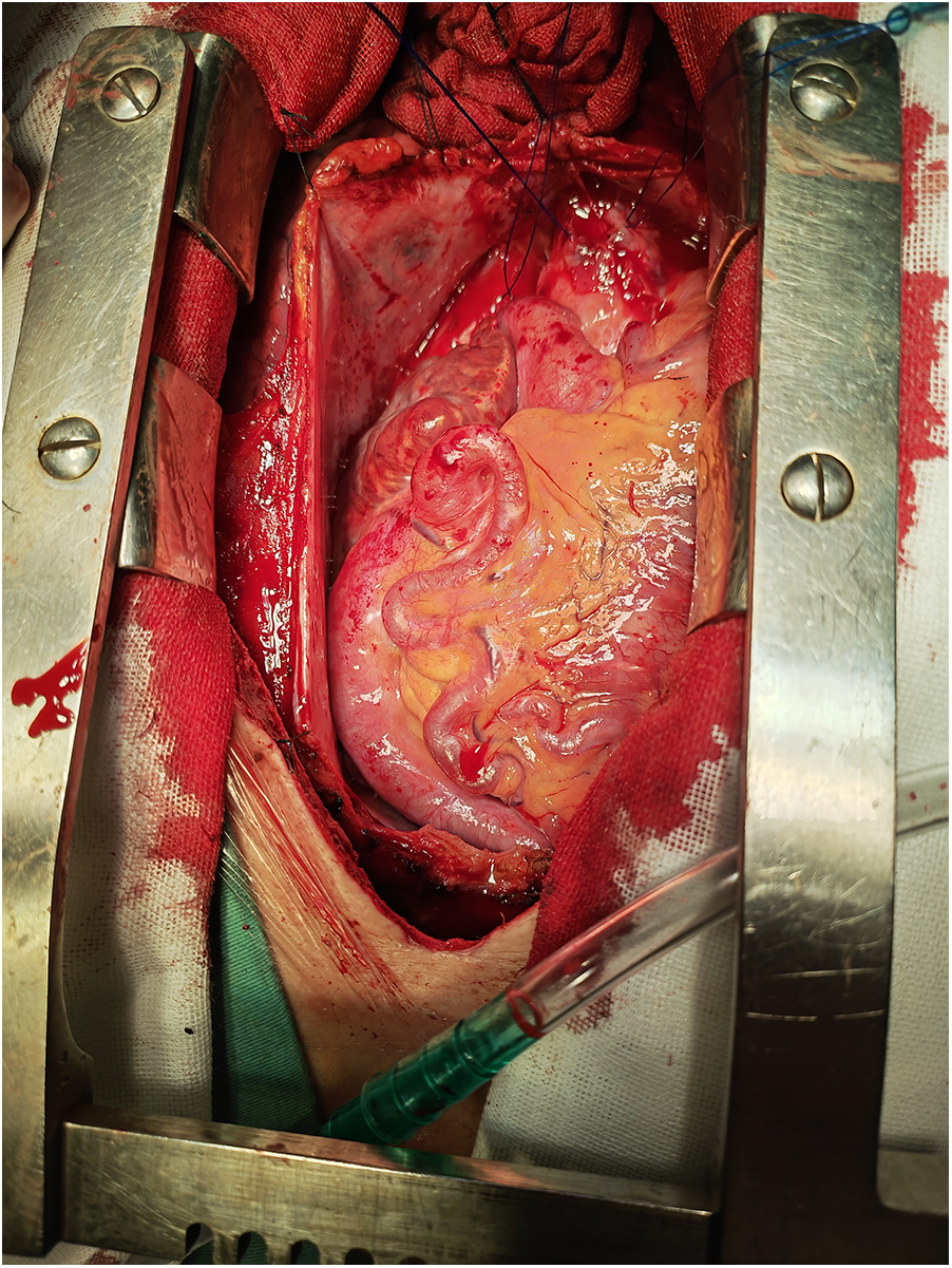 Surgical scene showing an exposed organ, likely intestines, within an open abdominal incision. Medical instruments and gauze are present, with visible blood and tissue.