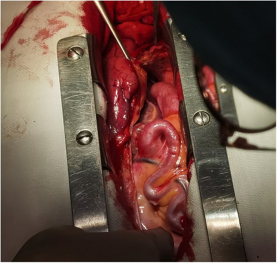 Surgical procedure showing an open abdominal area with exposed intestines, secured by metal retractors. A surgical instrument is visible, and there is blood present around the incision site.