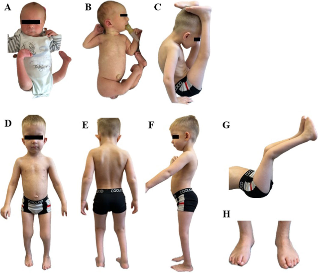 Eight panels (A-H) show a child at different ages and angles. Panels A and B depict an infant with joint contractures. Panels C to G display an older child in various postures, including extreme flexibility in panel C. Panel H shows the child's feet from the front. The child's eyes are obscured for privacy.