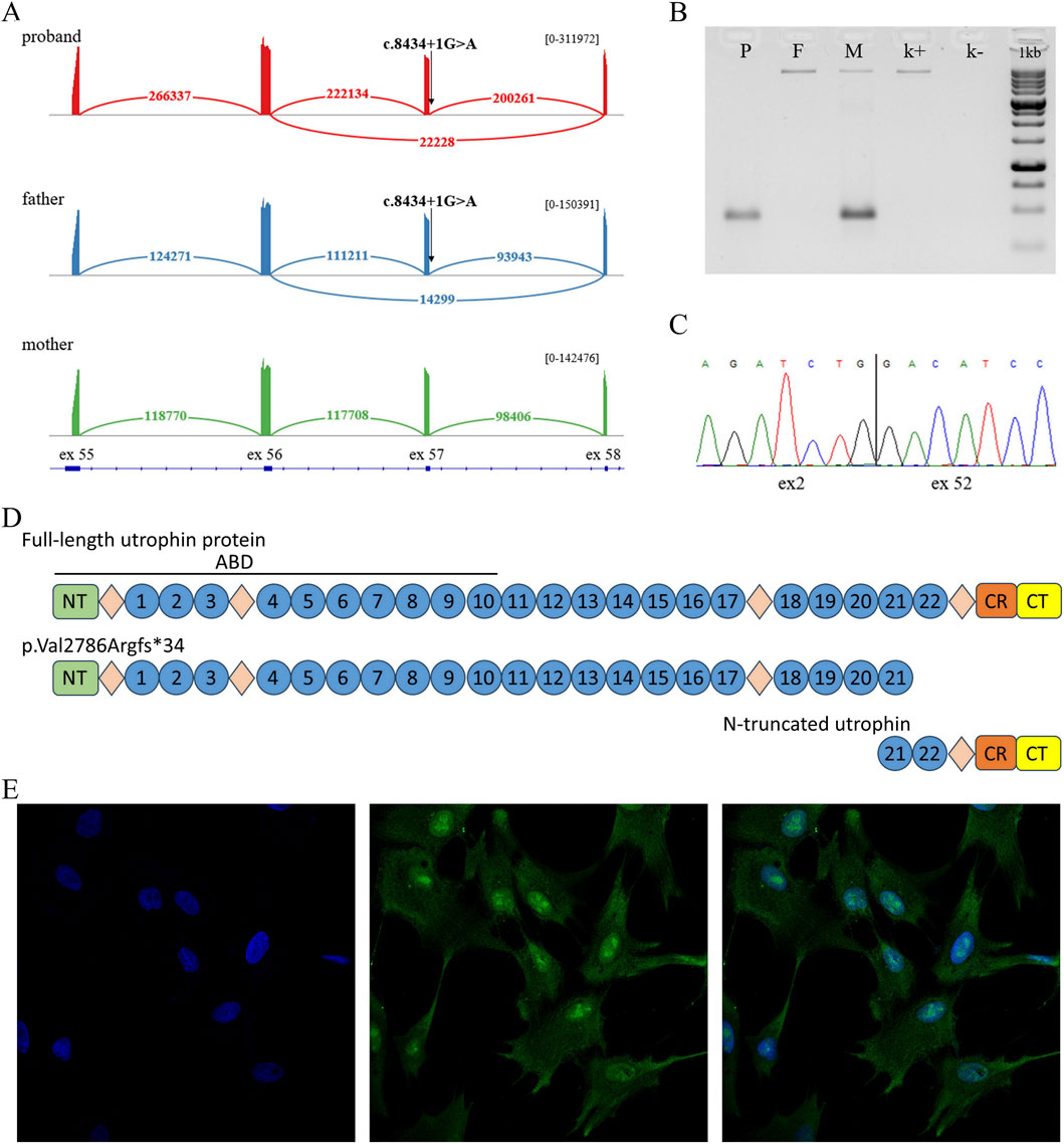A set of images displaying genetic analyses and related data. A) Chromatograms showing DNA sequences of the proband, father, and mother, highlighting a mutation c.8434+1G>A. B) Gel electrophoresis image showing bands for samples P (proband), F (father), M (mother), and controls. C) Sequencing chromatogram depicting genetic sequences near exons 2 and 52. D) Diagram illustrating full-length and N-truncated utrophin proteins, highlighting regions and mutations. E) Immunocytochemistry analysis of proband and parents shows different staining patterns, indicating protein expression levels.