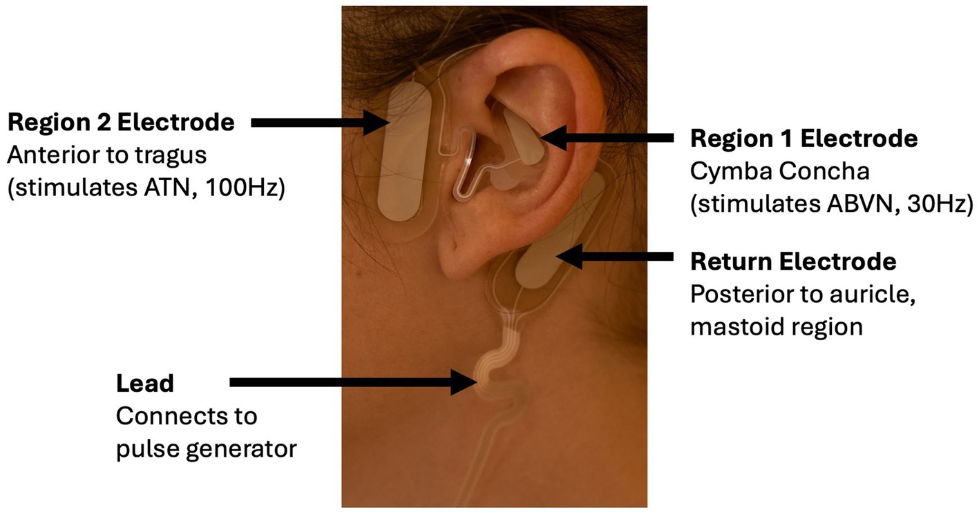 Close-up of a person’s ear with labeled electrodes. The Region 1 electrode is on the cymba concha to stimulate ABVN at 30 Hz. The Region 2 electrode is positioned anterior to the tragus to stimulate ATN at 100 Hz. The return electrode is posterior to the auricle in the mastoid region. A lead connects the electrodes to a pulse generator.