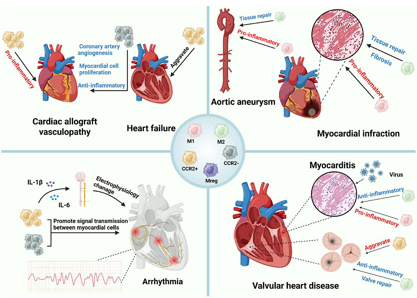 The diagram depicts cardiac macrophage polarization in heart disease. CCR2+ and M1 macrophages release IL-1β and IL-6, driving pro-inflammatory injury, fibrosis, arrhythmia, and the progression of myocardial infarction, myocarditis, heart failure, and vasculopathy. CCR2− and M2 macrophages secrete anti-inflammatory mediators that promote myocyte proliferation, coronary angiogenesis, and valve repair. Mreg cells provide regulatory control.