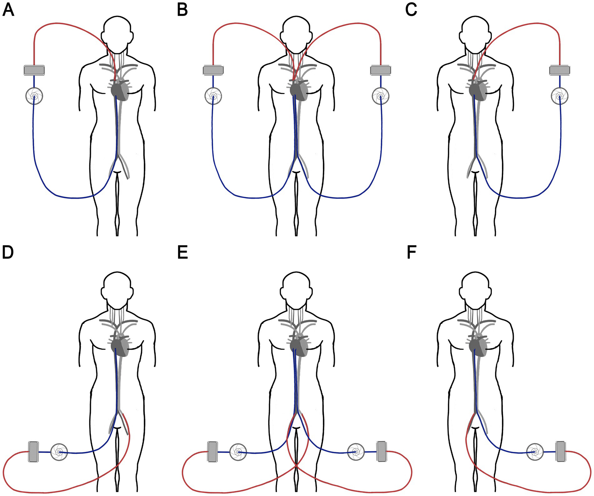 Illustration shows six diagrams labeled A to F, depicting different configurations of extracorporeal membrane oxygenation (ECMO) systems on a human figure. In A, B, and C, the ECMO circuit connects to the upper chest veins. In D, E, and F, the circuit connects to the lower body. Each diagram shows a heart and an oxygenator, with blue lines for venous and red lines for arterial connections.