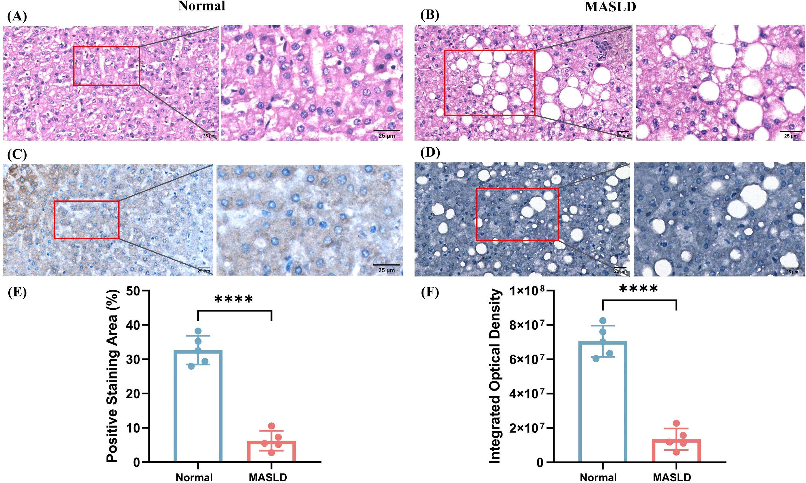 Histological comparison and analysis of liver tissue between normal and MASLD conditions. Panels A and B show tissue stained with H&E, highlighting cell structure differences. Panels C and D display immunohistochemistry results using different stains, revealing cellular variations. Panels E and F present bar graphs comparing positive staining area percentage and integrated optical density between normal and MASLD samples, with normal tissues showing higher values. Arrows and boxes in images indicate areas of interest. Scale bars measure 25 micrometers.