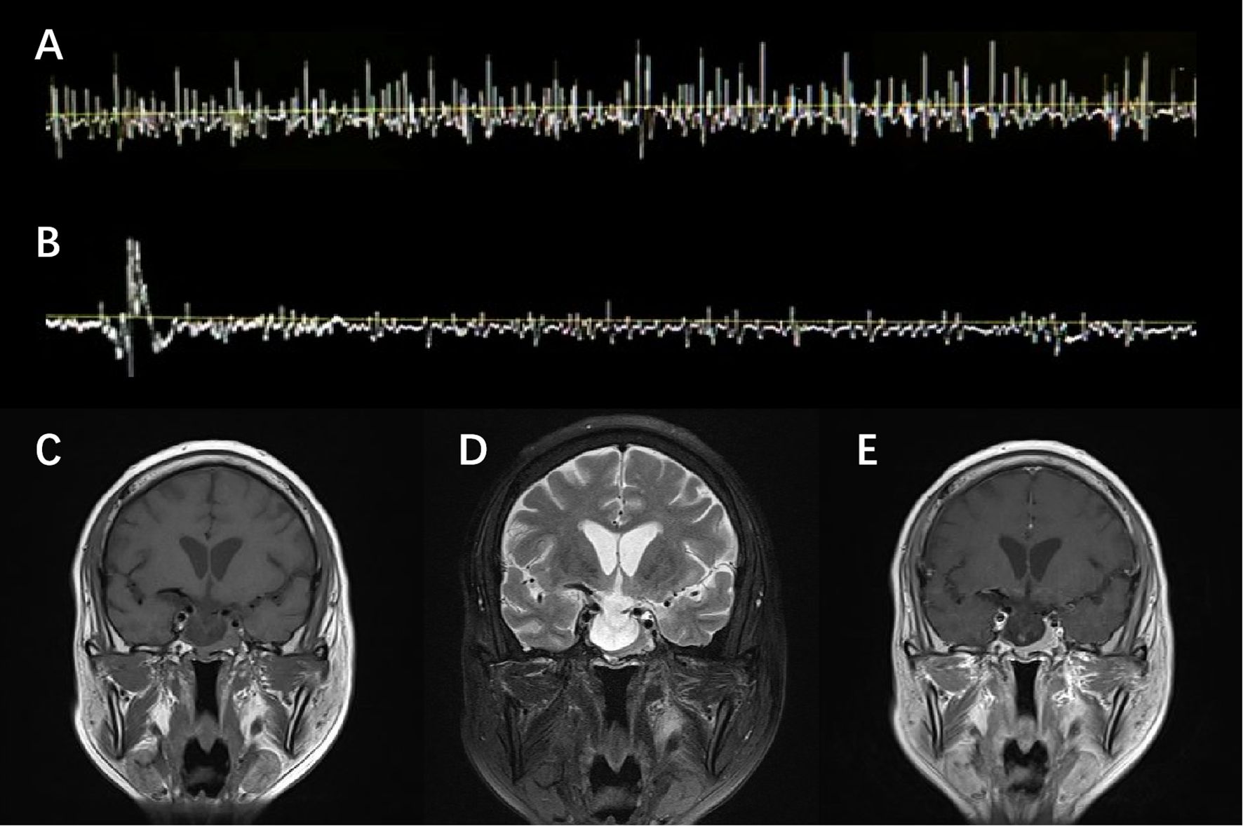 Electromyographic (EMG) pattern and brain MRI images of the patient. The top row labeled A and B includes EMG observations, showing spontaneous motor-unit potential firing at the resting state, which self-relieved without diazepam. The bottom row labeled C, D, and E includes coronal brain MRI images, displaying a heterogeneously enhanced pituitary and empty sella.