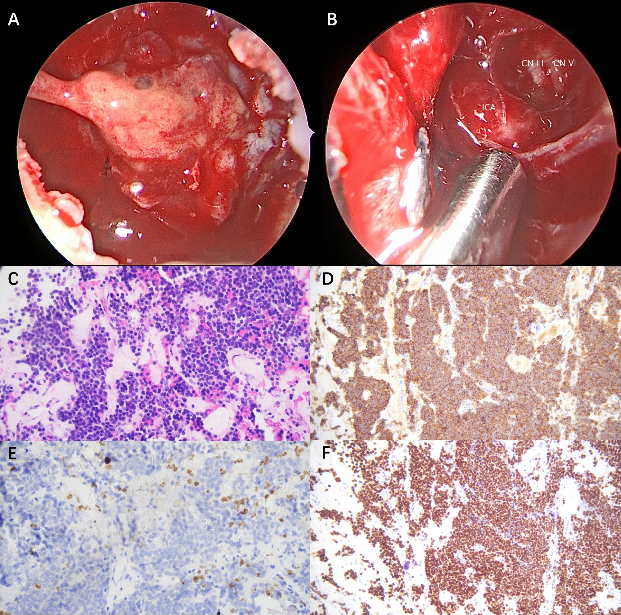 Intra-operative observation and post-operative biopsy (×200). A and B display intra-operative observations that a yellow gelatinous tumor invaded into the cavernous sinus, and the wrapped artery and nerves were exposed after tumor resection; C shows a histology slide with tumor cells; D, E, and F show immunohistochemistry slides with prolactin positivity, low proliferative index, and nuclear positivity, respectively.