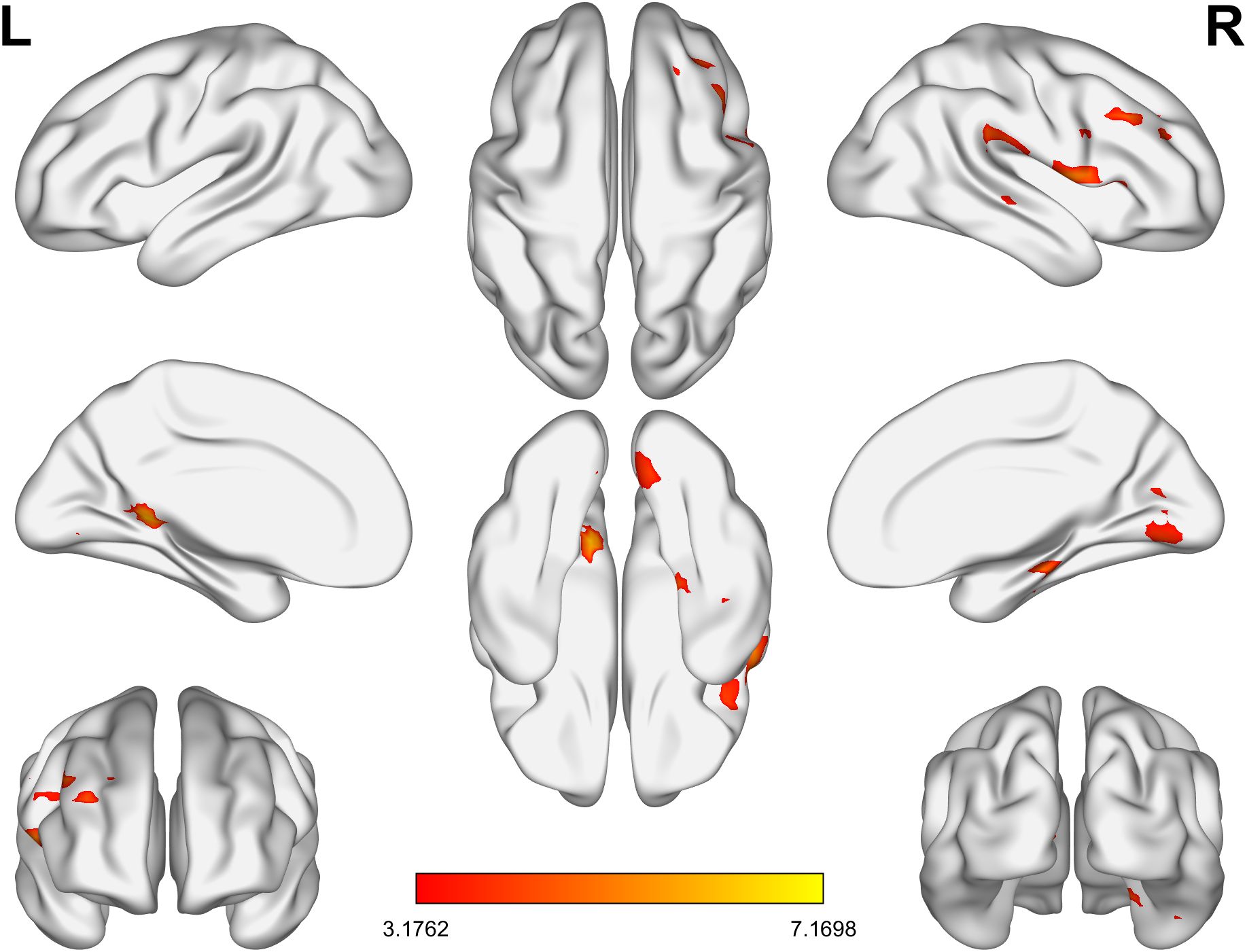 Visual representation of brain scans showing activation areas in red and orange across multiple views. The top row displays lateral views, the middle shows side views, and the bottom row provides frontal views. A color bar indicates activation strength from 3.1762 to 7.1698.