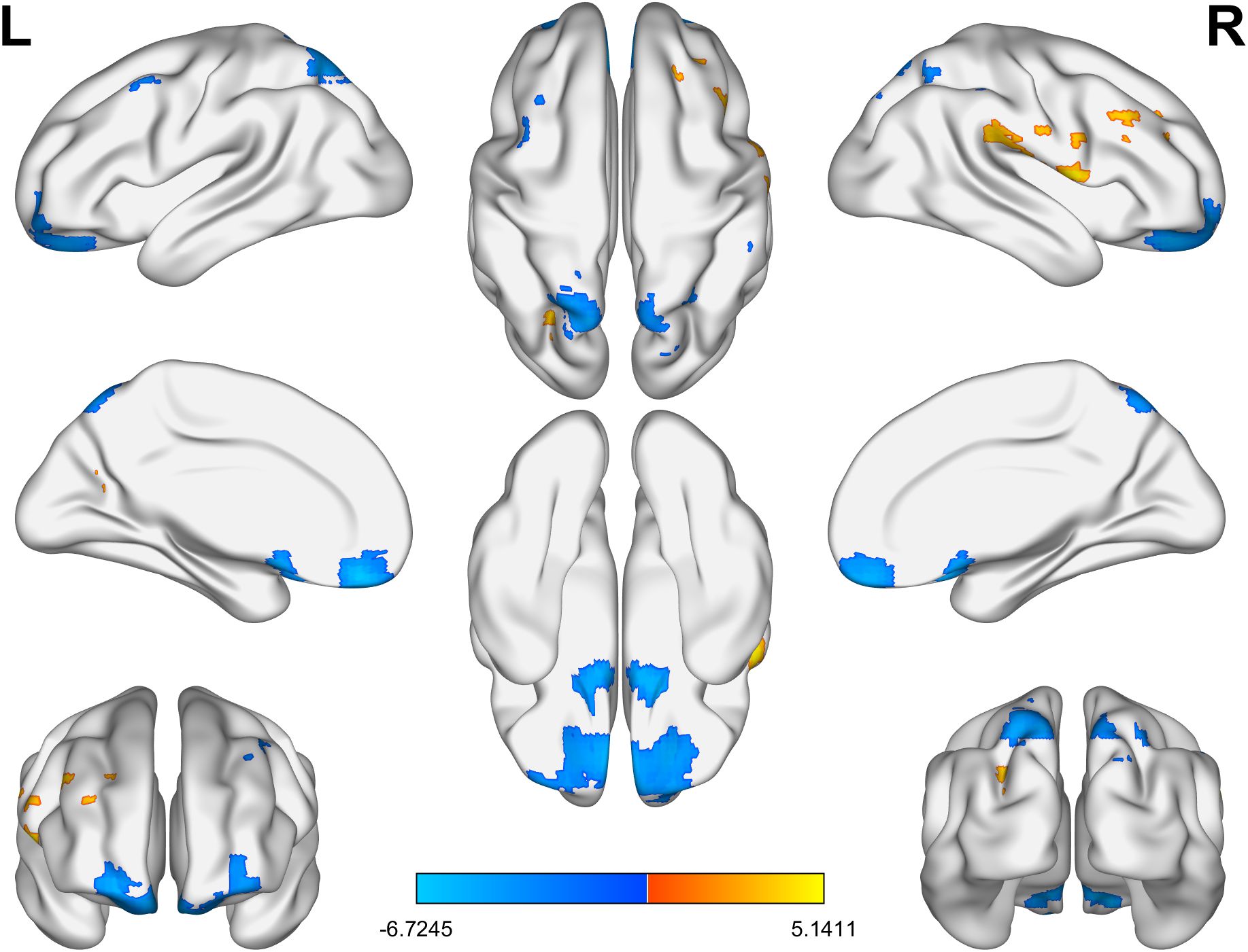 Brain activation maps on a 3D surface model show areas in blue and orange. The left and right hemispheres are labeled. Blue indicates lower activation while orange signifies higher activation, as per the color bar scale ranging from negative six point seven two four five to five point one four one one.