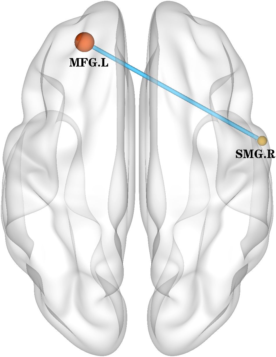 Diagram of a brain's inner structures, highlighting two regions: the left middle frontal gyrus (MFG.L) and the right supramarginal gyrus (SMG.R). A blue line connects these areas, indicating a functional relationship.