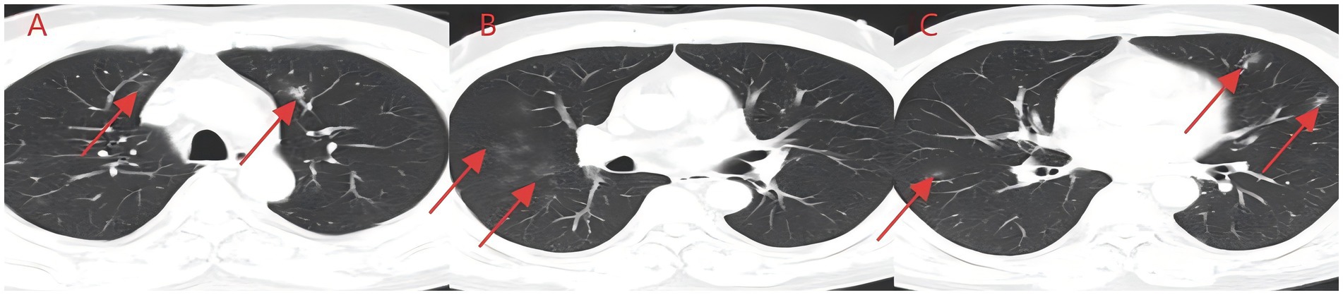 CT scan images of lungs labeled A, B, and C, showing different cross-sections. Red arrows highlight areas of interest in each section, indicating possible abnormalities or points for medical examination.