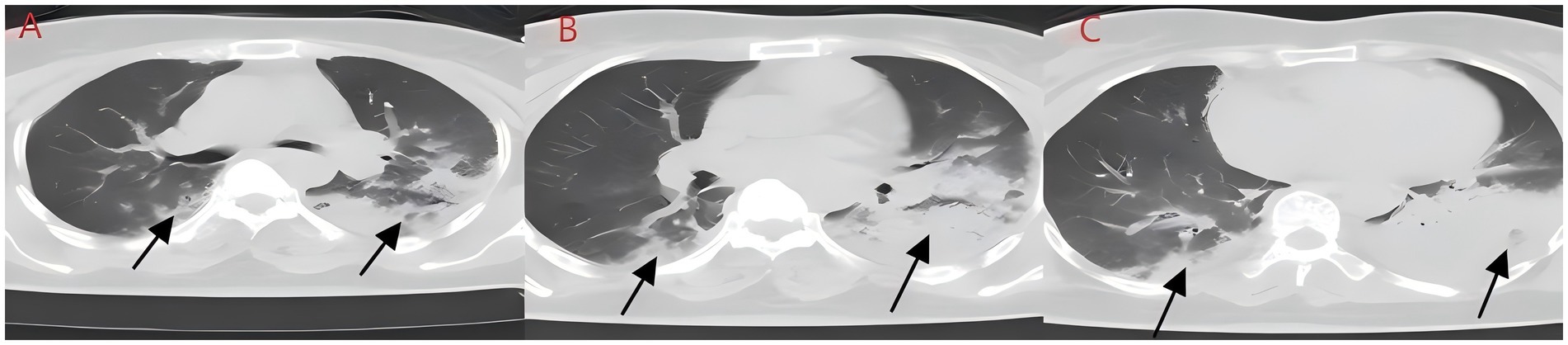 CT scan images labeled A, B, and C display cross-sectional views of the lungs with arrows indicating areas of interest. Darker regions and varying shades suggest differences in lung tissue, possibly highlighting abnormalities or areas of concern.