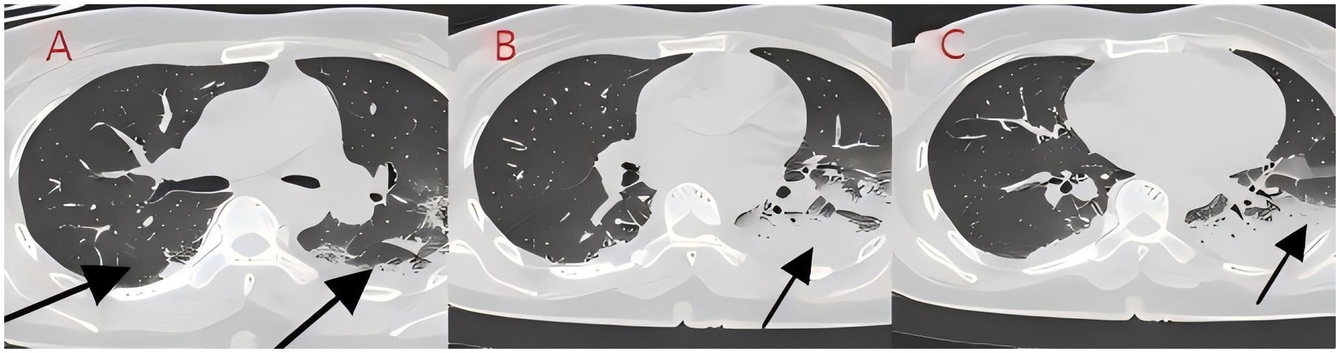 Three-panel CT scan image labeled A, B, and C showing cross-sections of the lungs. Each panel highlights darkened areas within the lungs, indicated by arrows, suggesting abnormalities or fluid accumulation.