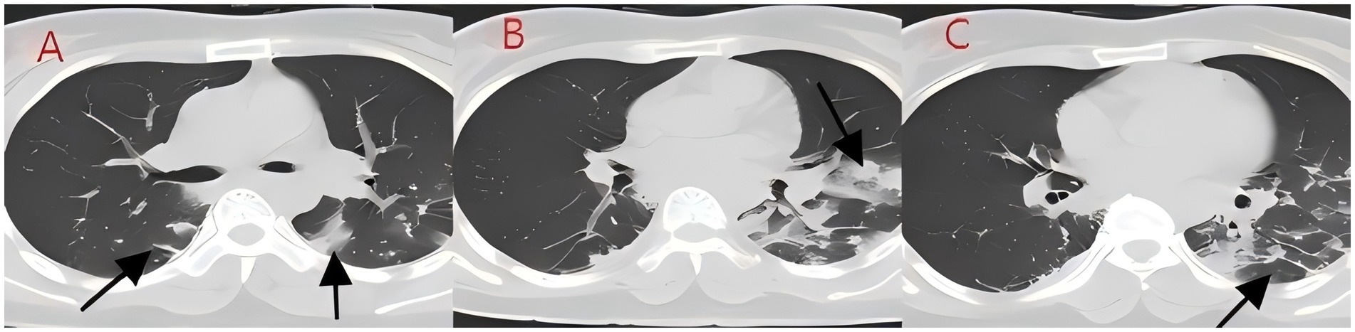 CT scan consisting of three panels labeled A, B, and C, illustrating sections of the chest. Each panel displays areas with dark and light contrasts. Arrows highlight different regions in each panel, suggesting focal points of interest or abnormalities.