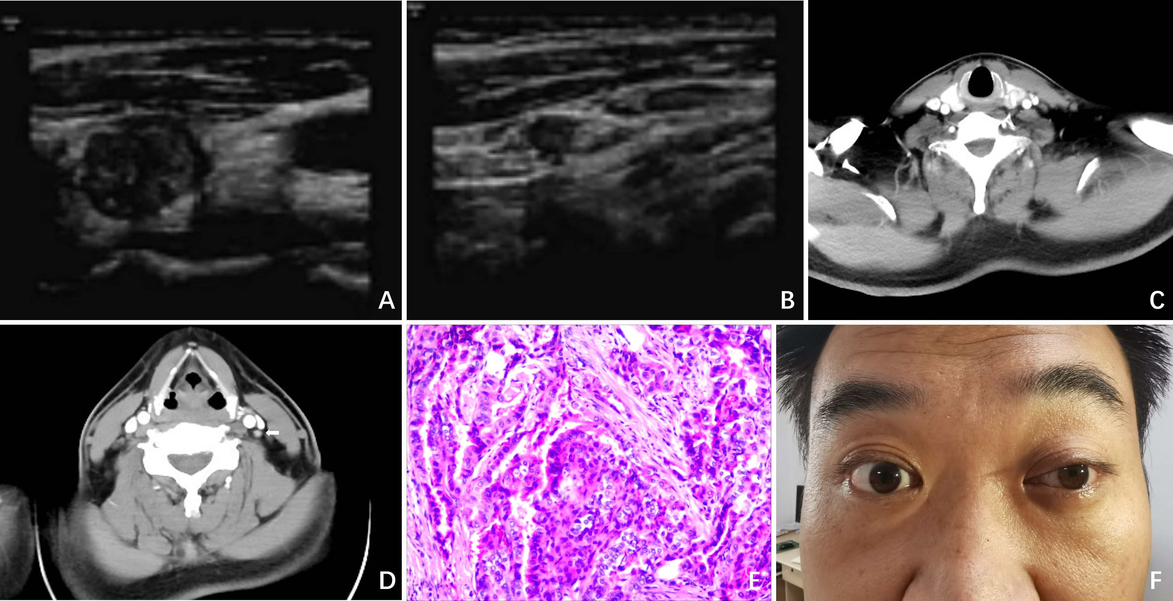 Composite medical images showing:  A) Ultrasound image with a nodule; B) Another ultrasound with different tissue density; C) Axial CT scan of the neck showing tissue contrast; D) Different CT slice highlighting anatomical features; E) Histological slide with cellular details in pink and purple; F) Close-up of a person’s face, one eye partially closed.