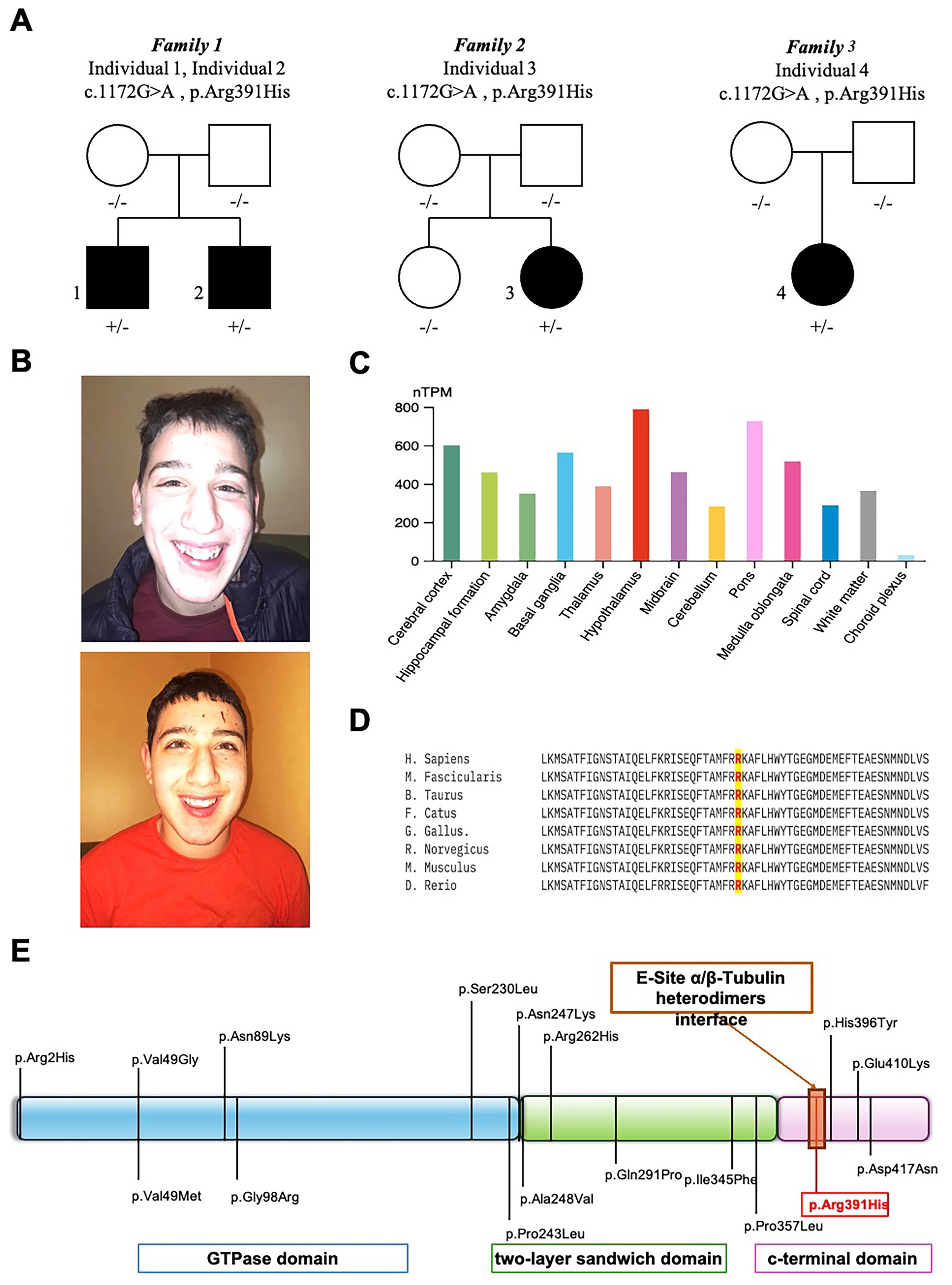 A composite image displays: (A) Pedigree charts for four families showing the genetic mutation c.1172G>A, p.Arg391His. (B) Two individual portraits of a young person smiling. (C) A bar chart showing nTPM expression levels across various brain regions. (D) An amino acid sequence alignment across different species, highlighting the Arg residue. (E) A diagram of the GTPase domain, two-layer sandwich domain, and c-terminal domain, with mutations noted, emphasizing Arg391His.