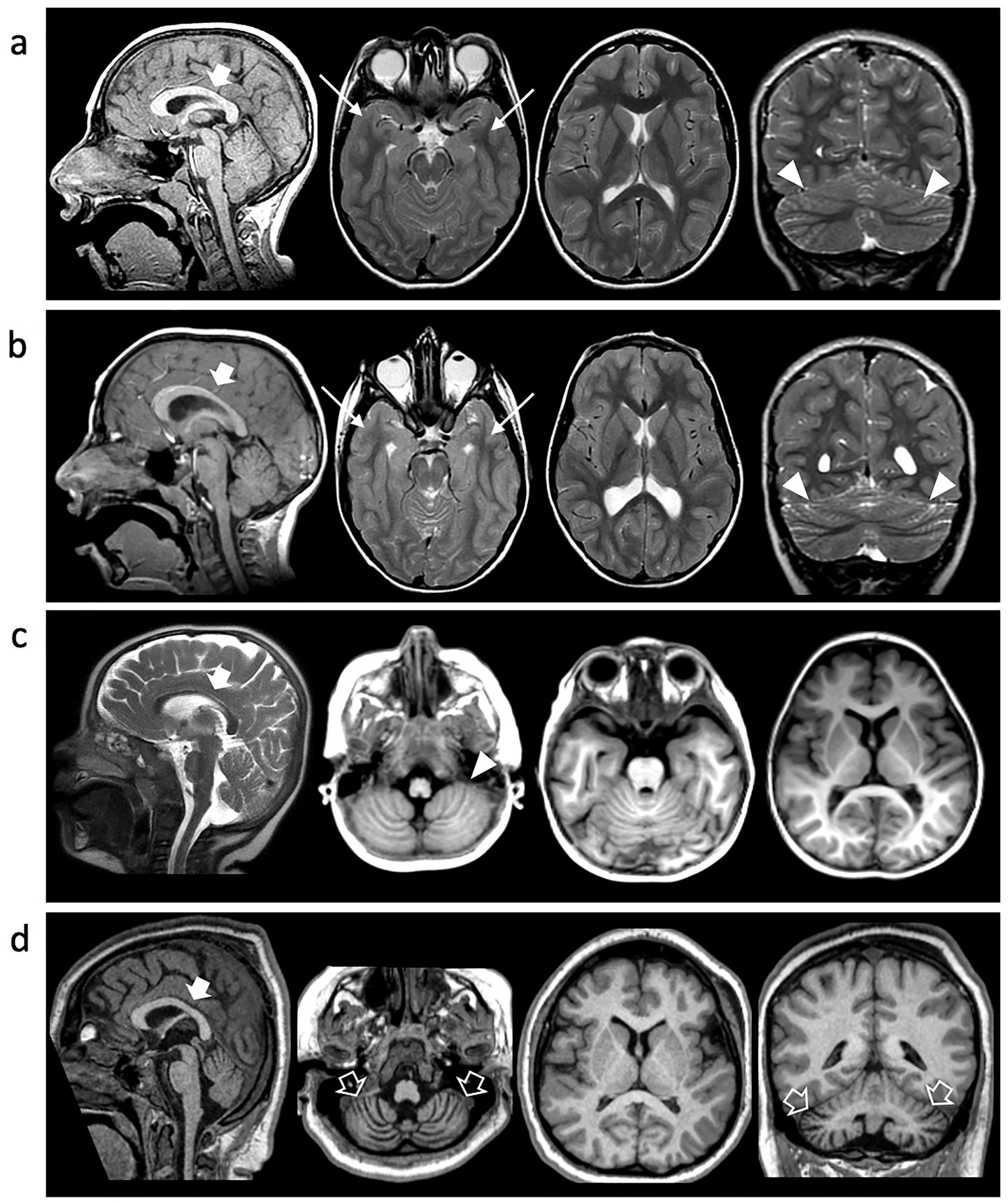 MRI scans of the brain are arranged in four rows labeled a, b, c, and d. Each row presents different views and sections with arrows indicating specific regions. Panel a and b highlight areas around the corpus callosum and cerebellum. Panel c focuses on the brainstem, and panel d shows various brain structures with emphasis on white-matter regions.