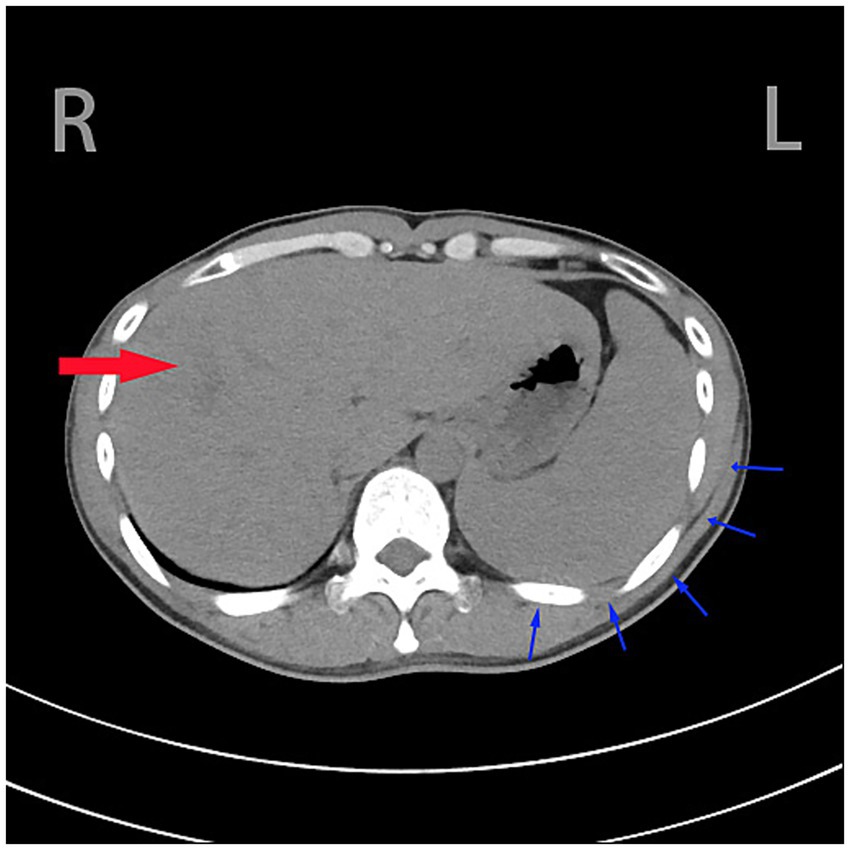 CT scan showing a transverse abdominal section. A red arrow on the left indicates fluid accumulation near the liver, while multiple blue arrows on the right highlight fluid at the periphery of the abdomen.