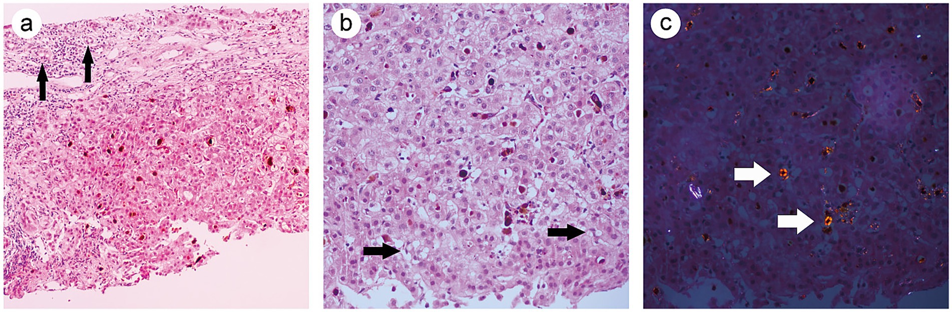 Three-panel microscopic images labeled a, b, and c display liver tissue samples with different staining techniques. Panel a shows moderate inflammation with dark arrows indicating clustered cells. Panel b highlights cellular degeneration with dark arrows pointing to affected areas. Panel c is color-enhanced, indicating fibrosis progression with bright arrows marking fibrotic regions.