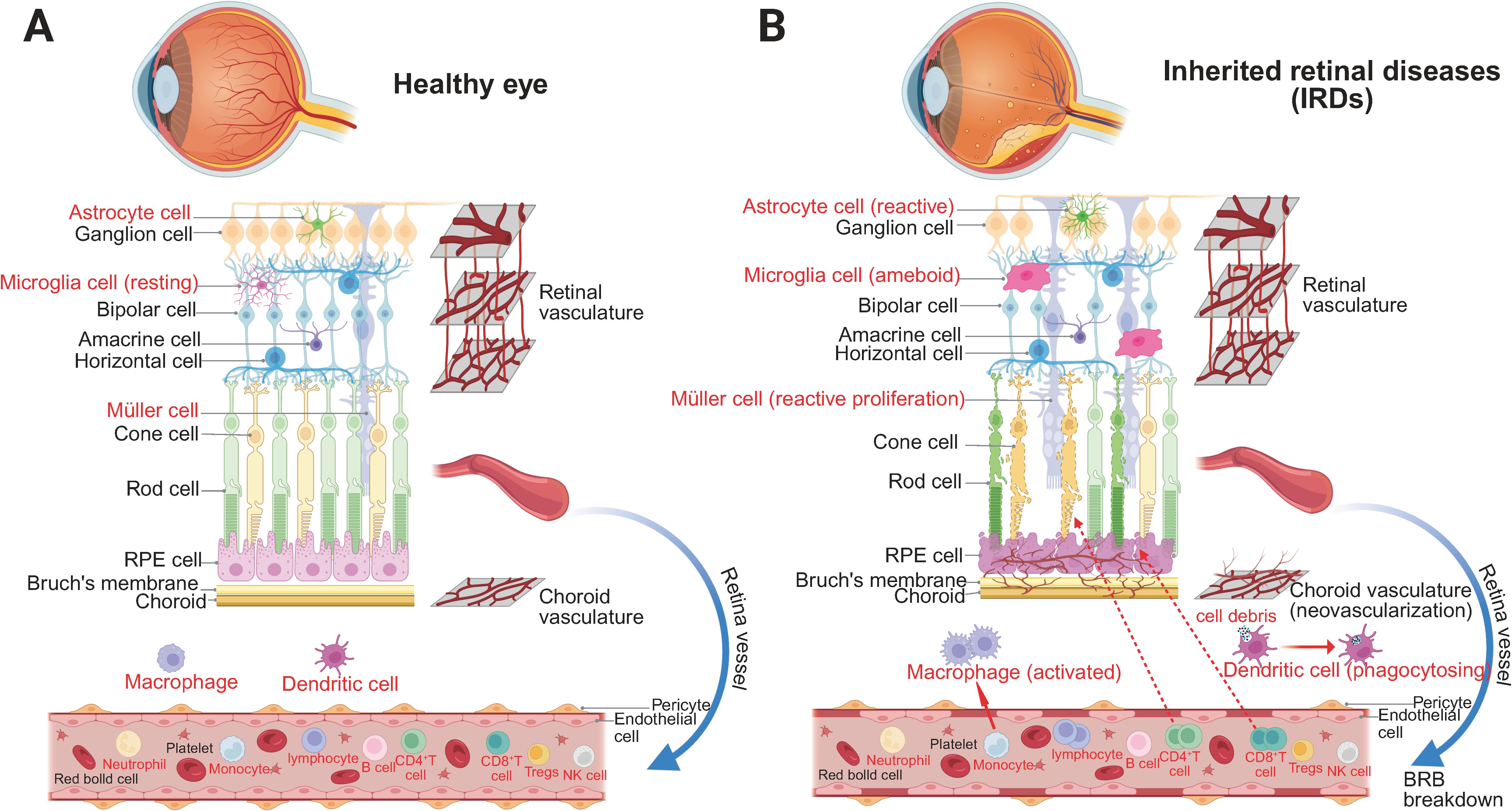 Diagram comparing a healthy eye (A) with an eye affected by inherited retinal diseases (B). Panel A shows normal cellular structure including astrocytes, microglia, Müller cells, retinal vasculature, photoreceptor, and RPE cells. Panel B illustrates reactive changes like activated astrocytes, ameboid microglia, reactive Müller cell proliferation, and choroid neovascularization, with macrophage and dendritic cell activity highlighting breakdown of the blood-retinal barrier.
