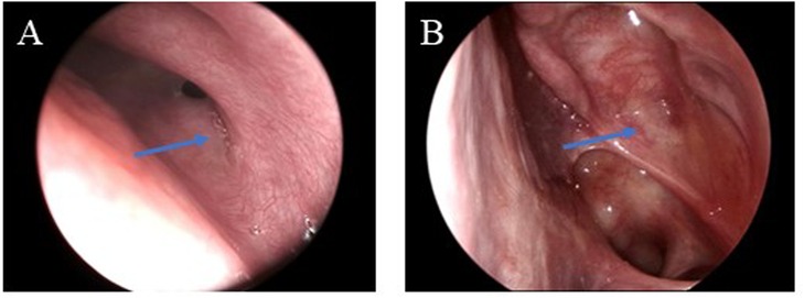 Endoscopic images showing internal views of a body passage. Panel A shows a smooth, pinkish tissue surface with a blue arrow indicating a specific area. Panel B depicts a closer view of a different section with similar tissue texture, also marked by a blue arrow.
