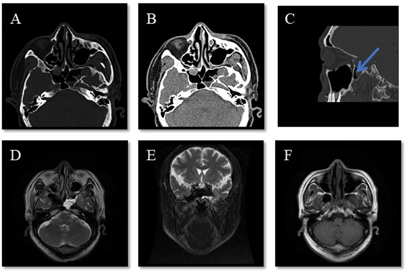 Six-panel medical image with labeled sections A to F. Panels A and B are axial CT scans of the skull, showing different tissue densities. Panel C is a sagittal view CT scan with an arrow indicating a specific area of interest. Panels D, E, and F are MRI scans, with D and F showing axial views and E showing a coronal view, highlighting various brain structures.