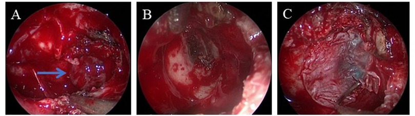 Medical endoscopic images labeled A, B, and C show a sequence of procedures or conditions. Image A features a blue arrow pointing to a specific area. The images display various tissues in red hues, indicating examination or surgery.