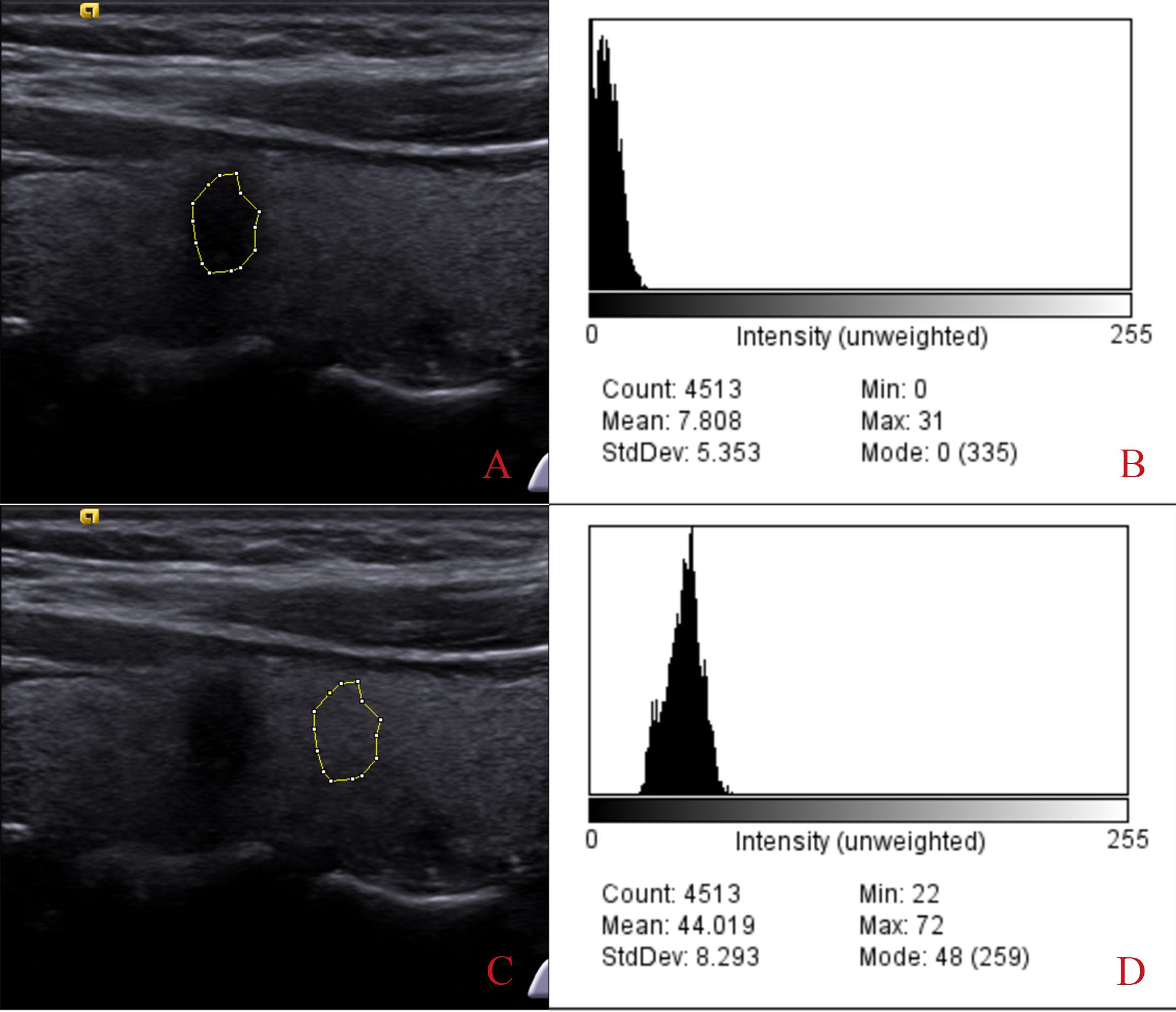 Ultrasound images titled A and C display a marked area within tissue. Adjacent histograms, labeled B and D, show intensity distributions for these areas. Image B's histogram presents lower intensity values with a mean of 7.808, while D's histogram shows higher values with a mean of 44.019. Both histograms represent unweighted intensity measurements from zero to two hundred fifty-five.