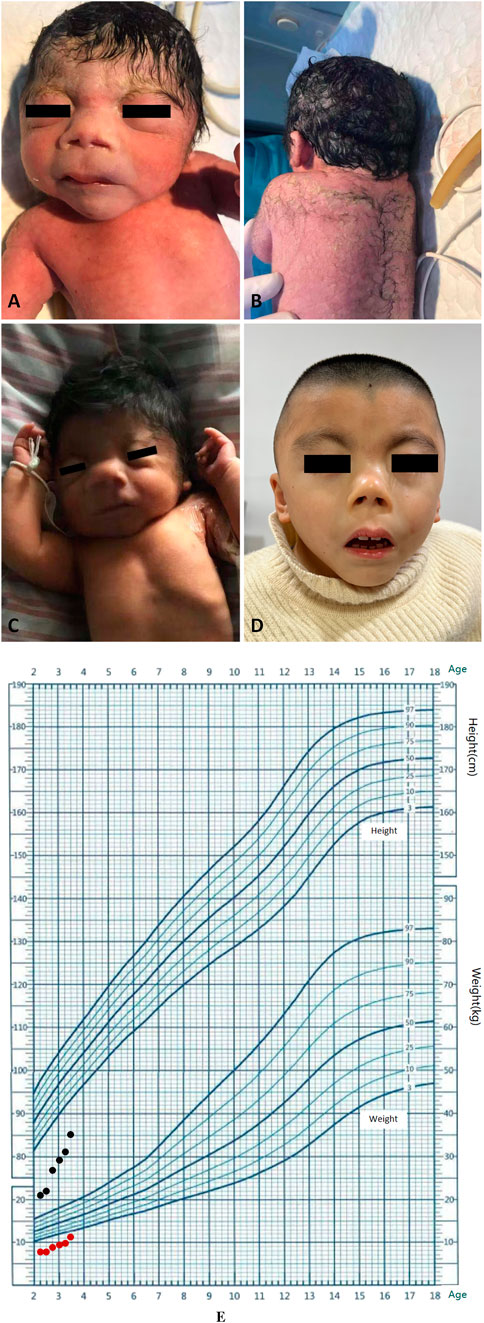 Panel A shows a newborn with fine dark hair, closed eyes, and a neutral expression. Panel B shows the back of a newborn with fine hair on the skin. Panel C shows the newborn in a hospital bed with slightly raised arms. Panel D shows the same child aged a few years, wearing a white sweater, and having a neutral expression. Panel E is a growth chart illustrating height and weight percentiles for age with data points plotted for an individual.