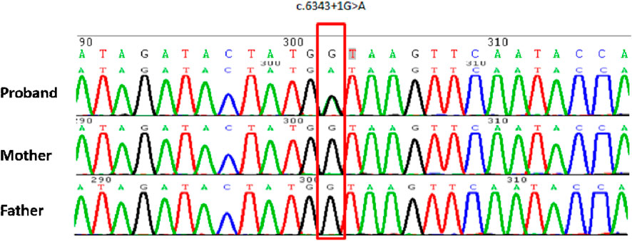 Electropherogram showing DNA sequence traces for a proband and their parents. The sequences are marked with peaks representing nucleotides A, T, C, and G in different colors. A red box highlights a G to A substitution at position c.6343+1 in the proband, altering splicing.