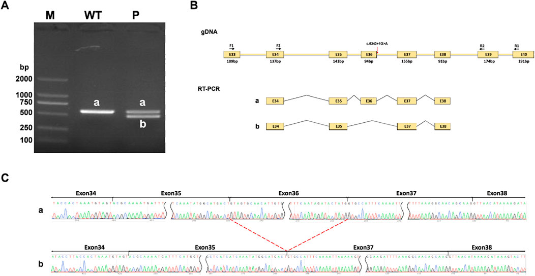 Panel A shows a gel electrophoresis with bands at different base pair lengths labeled M, WT, and P, with distinct bands marked as a and b. Panel B displays gene diagrams, illustrating genomic DNA and RT-PCR product arrangements, with exons labeled E33 to E40. Panel C presents DNA sequencing chromatograms, highlighting exon sequences with a variation in splicing patterns between samples a and b. Red arrows in panel C indicate connections between splicing variations.