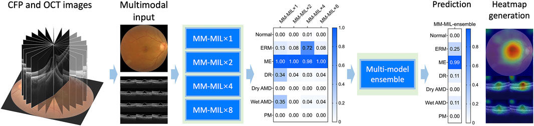 CFP and OCT images are used as multimodal input for diagnostic analysis. The process involves multiple models (MM-MIL) to predict conditions like ERM, ME, DR, Dry AMD, Wet AMD, and PM. The prediction results, scored on a scale from zero to one, are presented with a heatmap for visualization. A multi-model ensemble enhances prediction accuracy.