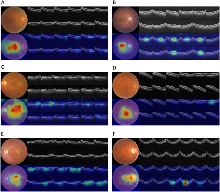 Fundus images (A-F) paired with OCT scans and thickness heat maps. Each panel shows a retinal image, corresponding OCT slices, and heat maps indicating retinal layer thickness variations. Panel A shows a normal retina, while Panels B-F display various retinal pathologies with distinct thickness anomalies seen in heat maps, such as macular edema and drusen. OCT scans reveal structural changes correlating with the observed thickness in heat maps.