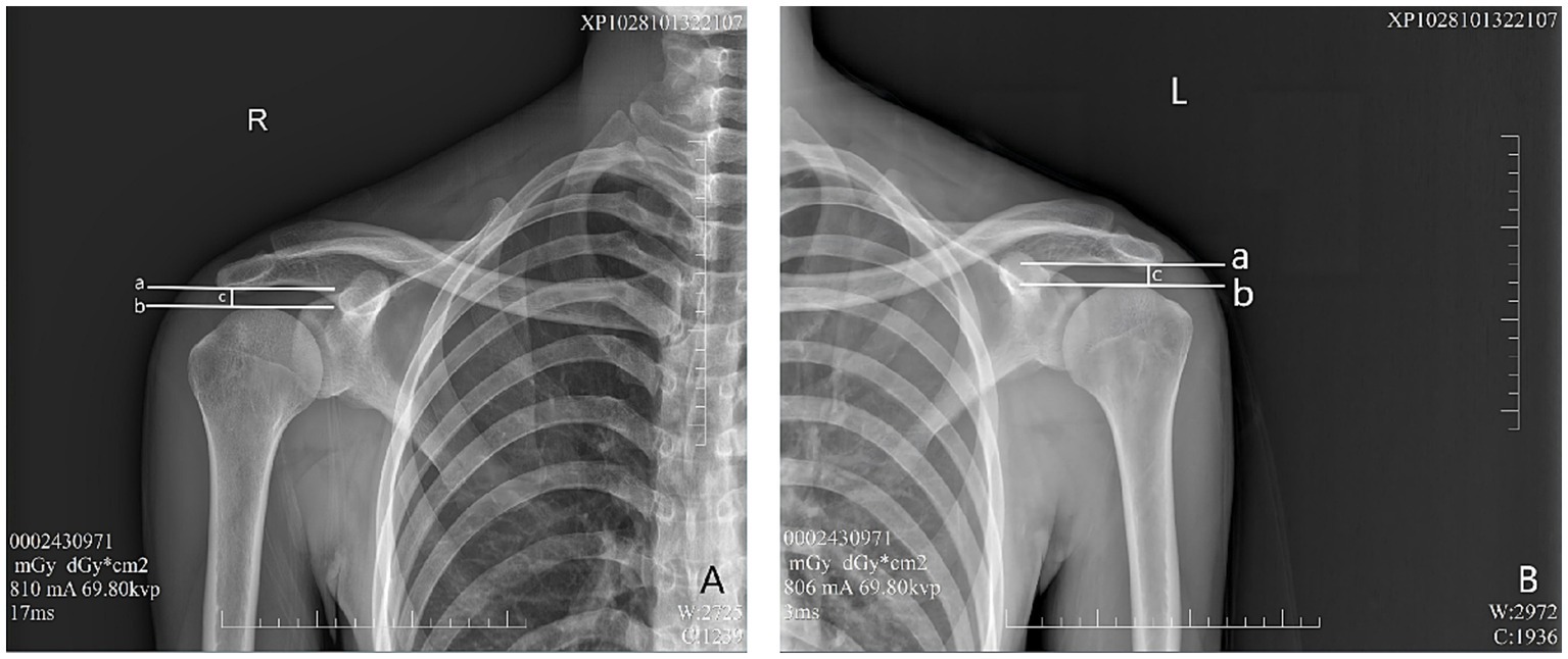 X-ray images of both shoulders, showing the clavicle and upper humerus. The right side is labeled